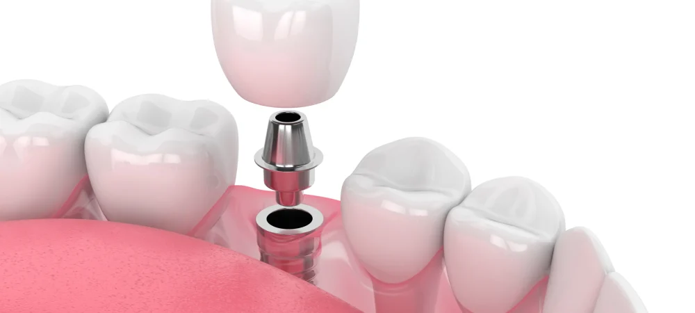 implantes dentales